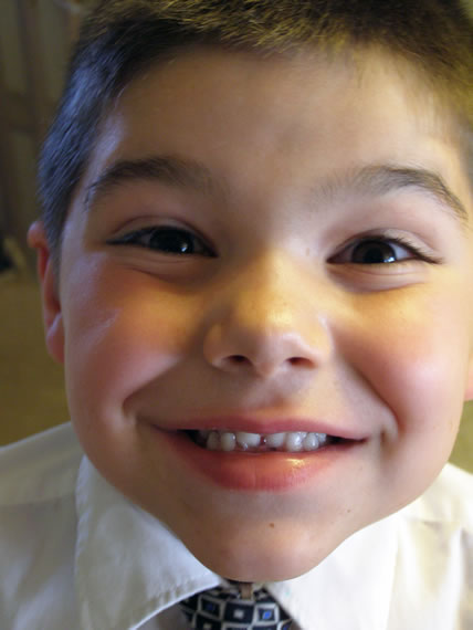 Lost tooth